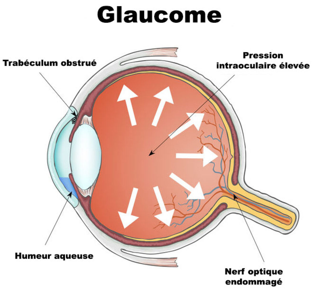 Glaucome : pourquoi le dépistage précoce change tout